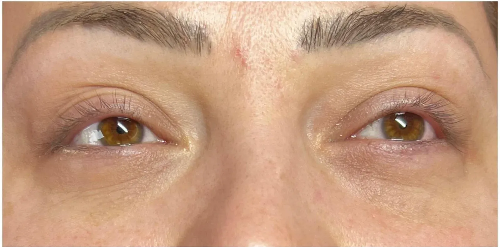 CCeye Behandlung der Augenpartie, beide Augen im Vergleich nachher