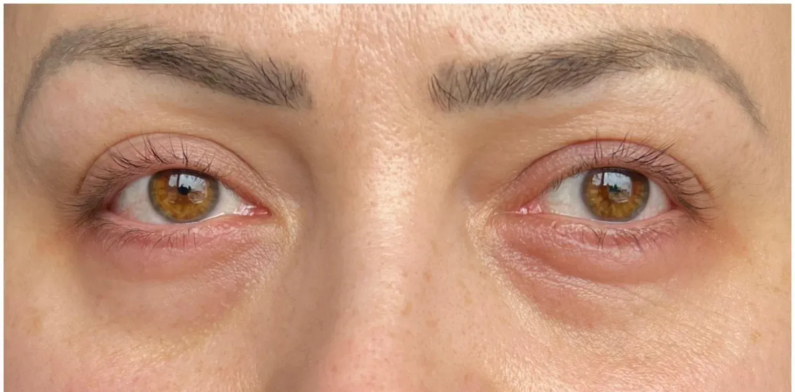 CCeye Behandlung der Augenpartie, beide Augen im Vergleich vorher